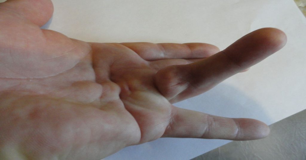 Dupuytren Kontraktürü 2 Dupuytren Kontraktürü