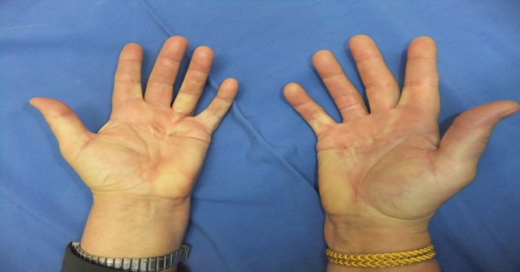 Dupuytren Kontraktürü 3 Dupuytren Kontraktürü