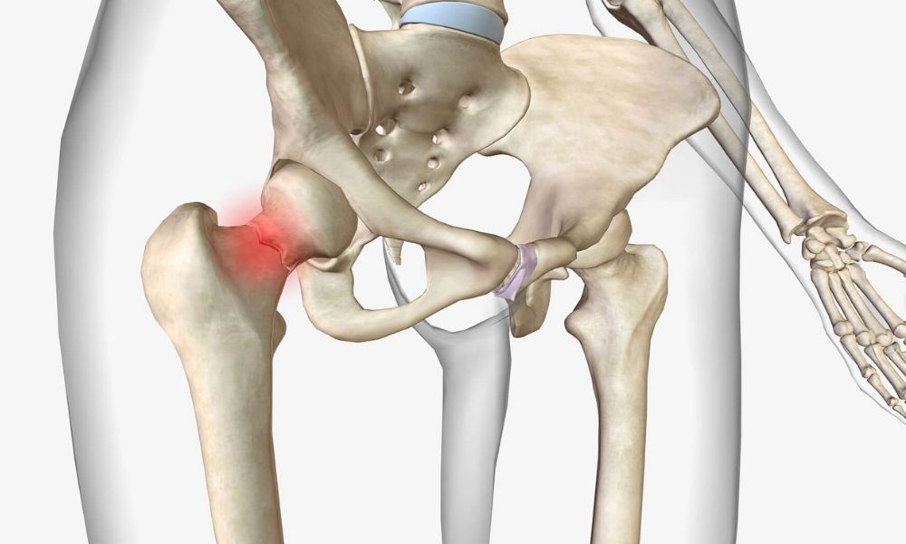 Femoral Anteversiyon