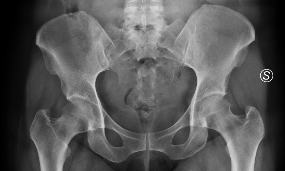 Femoral Anteversiyon 3 Femoral Anteversiyon