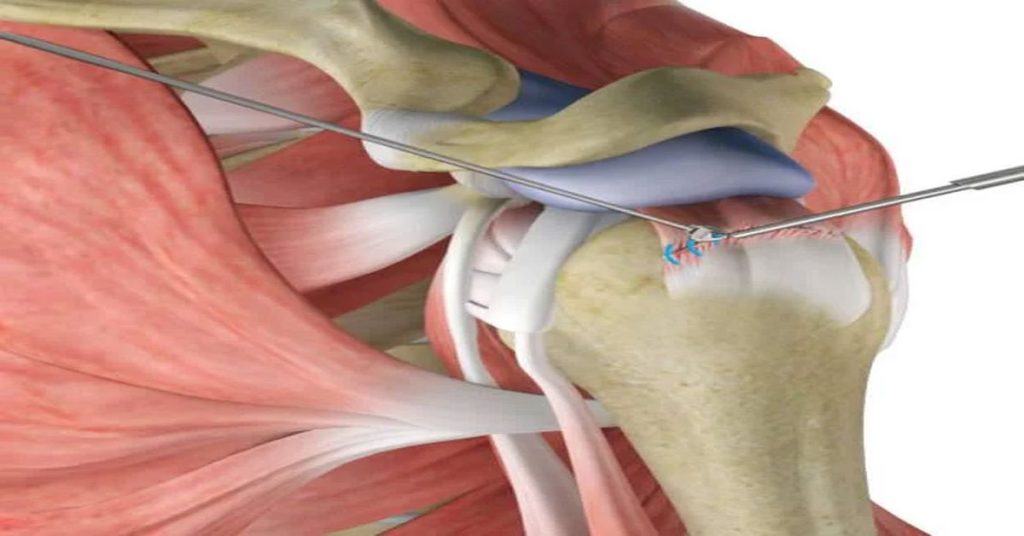 Omuzda Labrum Yırtığı
