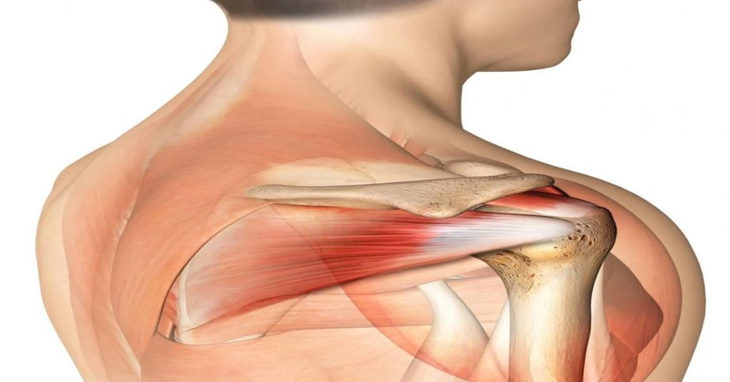 Omuzda Labrum Yırtığı 3 Omuzda Labrum Yırtığı