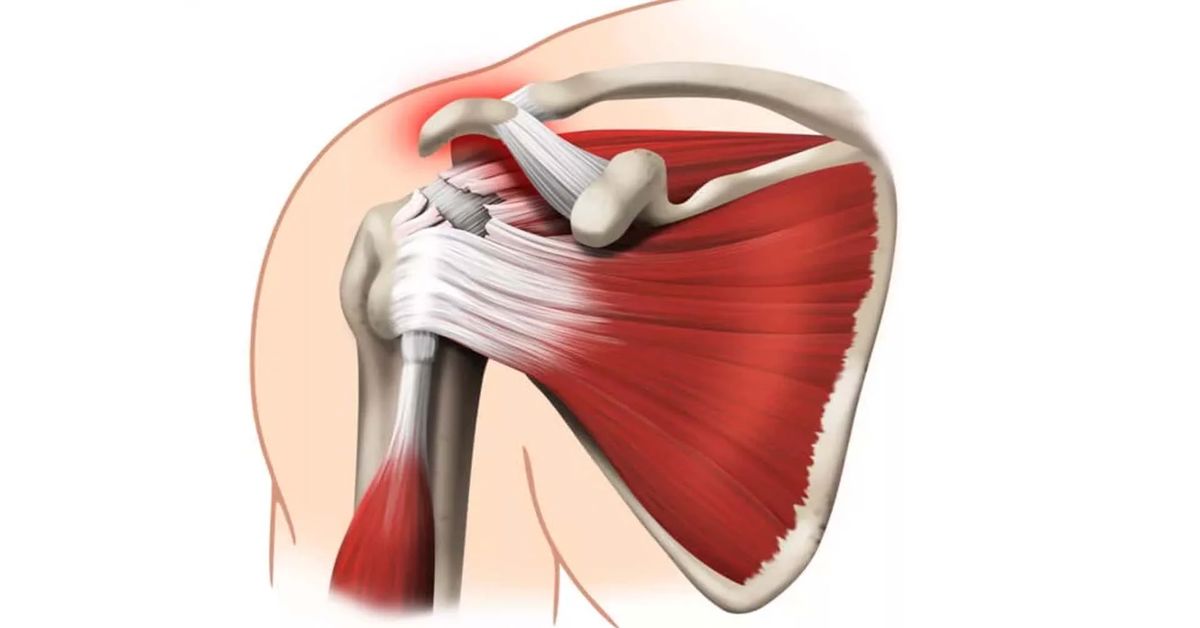 Omuzda Labrum Yırtığı