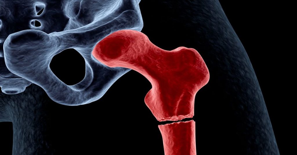 Yaşlılarda Kalça Kırığı 2 Yaşlılarda Kalça Kırığı