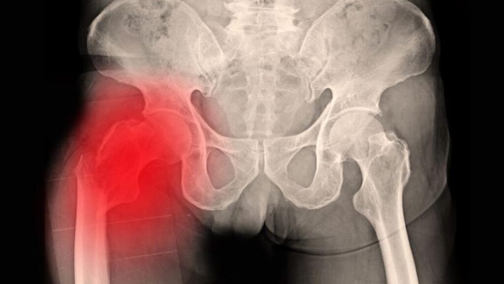 yaslilarda kalca kirigi 2