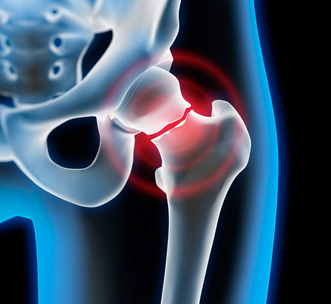 Yaşlılarda Kalça Kırığı