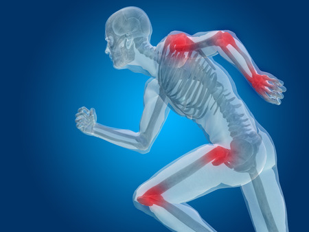 Eklem İltihabı 2 eklem iltihabi 1