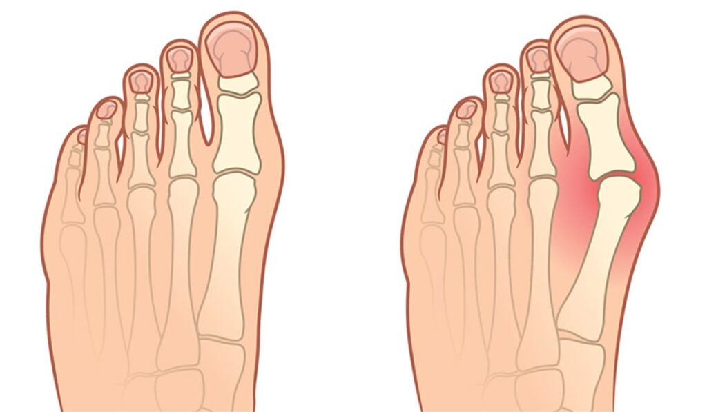 halluks valgus 1