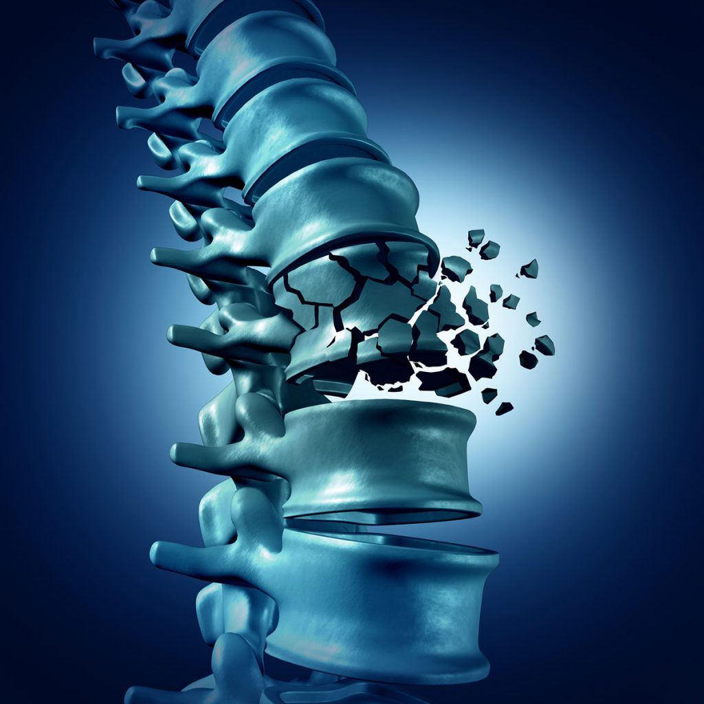 Omurga Kırığı