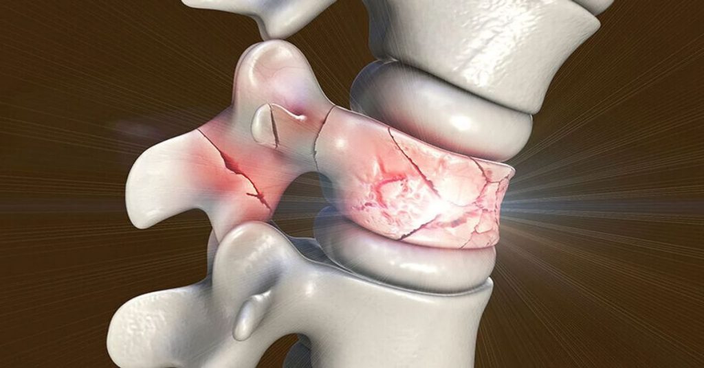 Omurga Kırığı 2 Omurga Kırığı