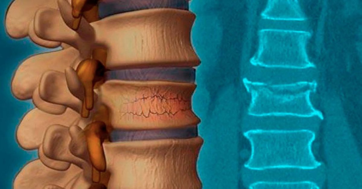 Omurga Kırığı 6 Omurga Kırığı