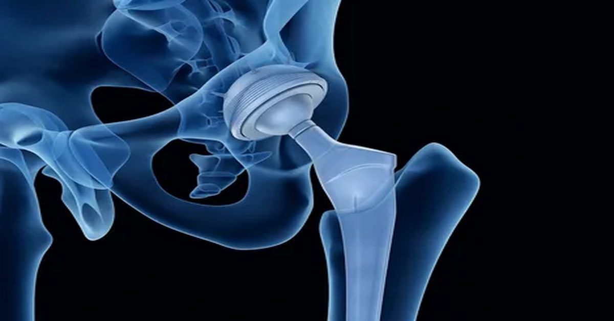 Kalça Protezi Ameliyatı Nedir?
